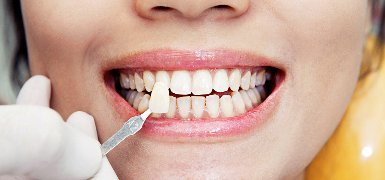 Anhand eines Zahnmusters wird bestimmt, welche Farbe der künftige Zahnersatz hat. 