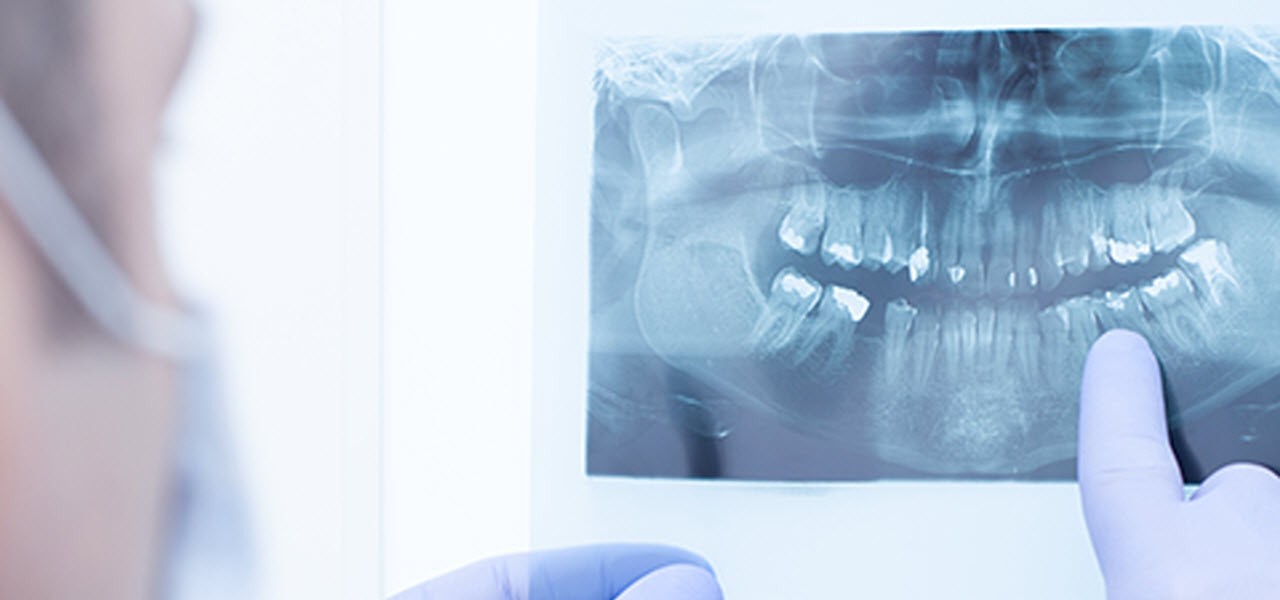 Amalgam im Mund | ERGO