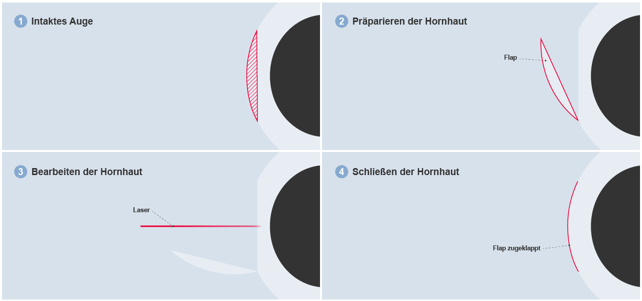 Grafik Augenlaseroperation