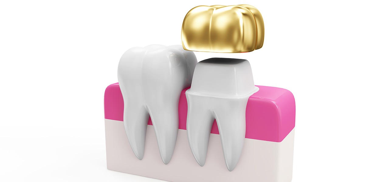 Modell einer Zahnkrone aus Gold